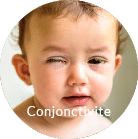 Conjonctivite