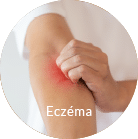 Eczema